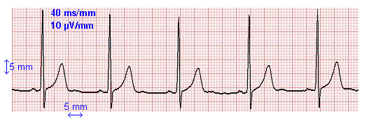 Description : Résultat de recherche d'images pour "electrocardiogramme"
